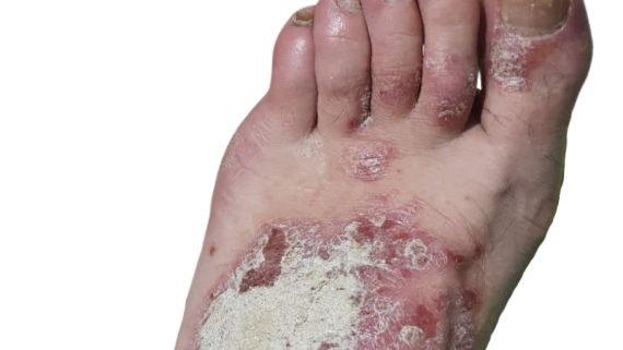 Psoriasis