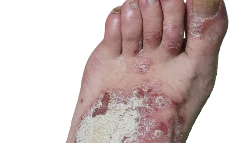 Psoriasis