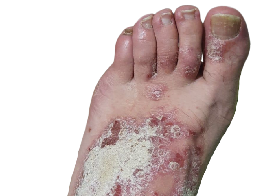 Psoriasis