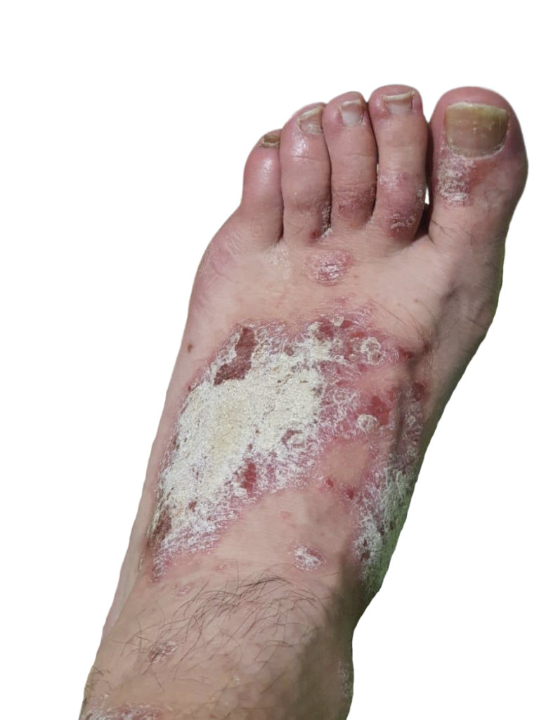 Psoriasis pie