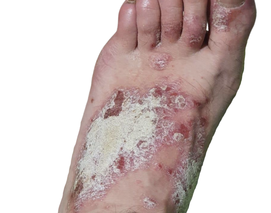 Psoriasis pie