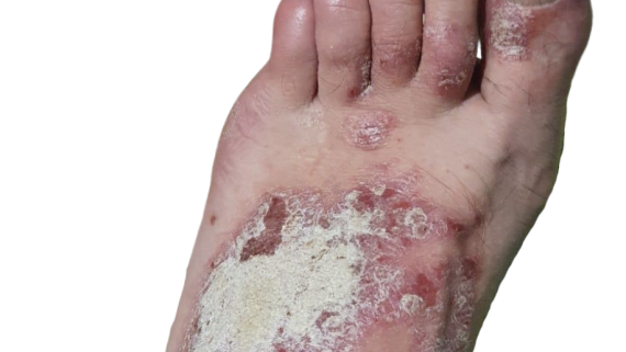 Psoriasis pie