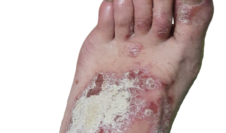 Psoriasis pie